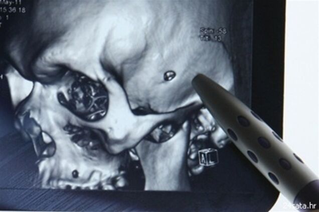 В Боснии вратарь отыграл весь футбольный матч с пулей в голове