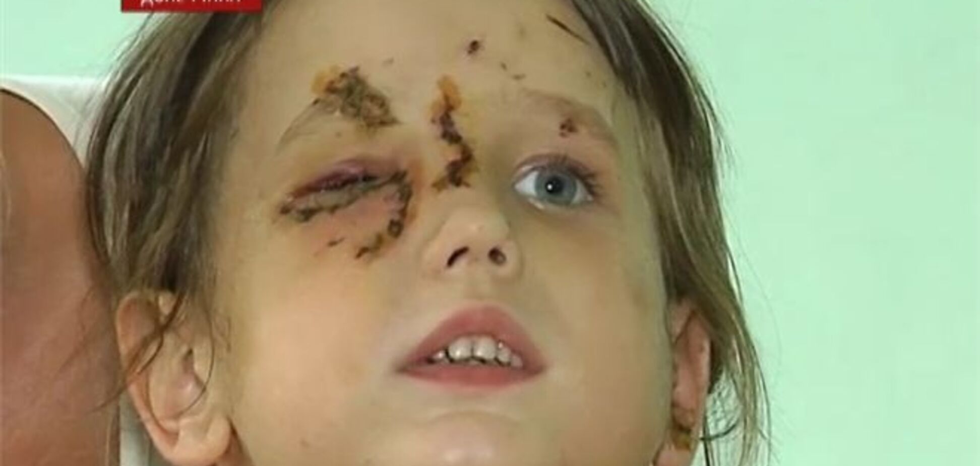 На Донетчине пьяный хозяин наблюдал, как его собака кромсает девочку