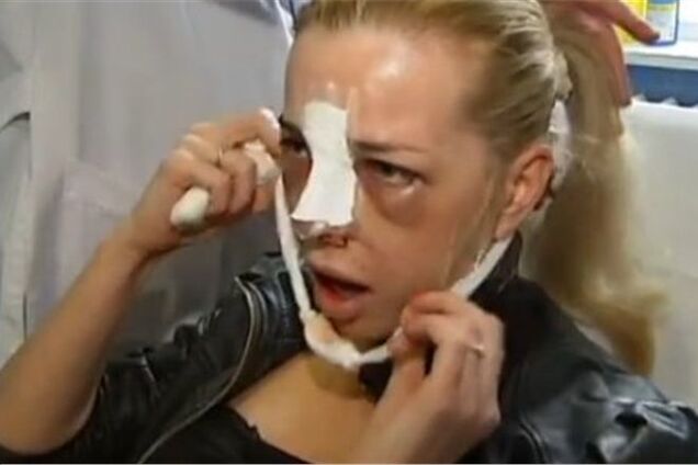 Звезда шоу 'Холостяк' показала изувеченное лицо