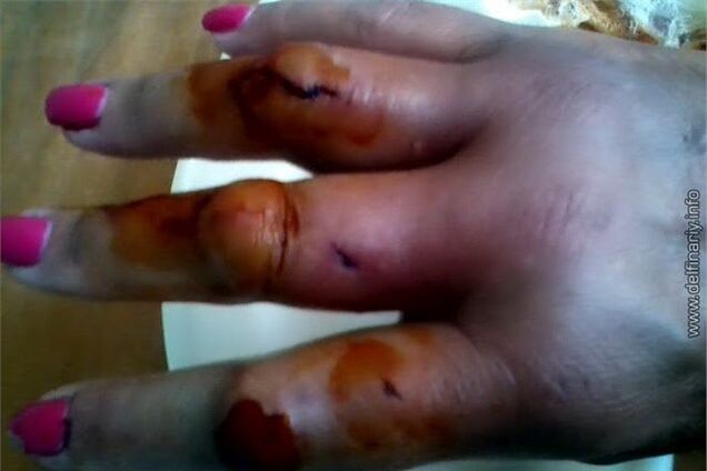 У Криму дельфін ледь не відкусив жінці руку