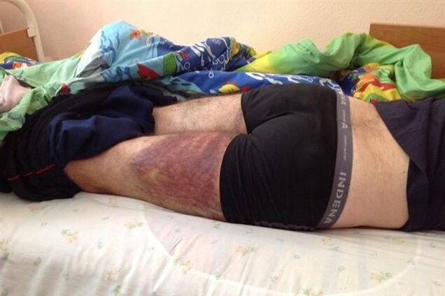 Геращенко о травмах пострадавших в Черкассах: Это средневековье!