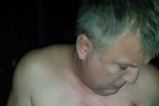 В Киеве избили кандидата в нардепы от партии Ляшко