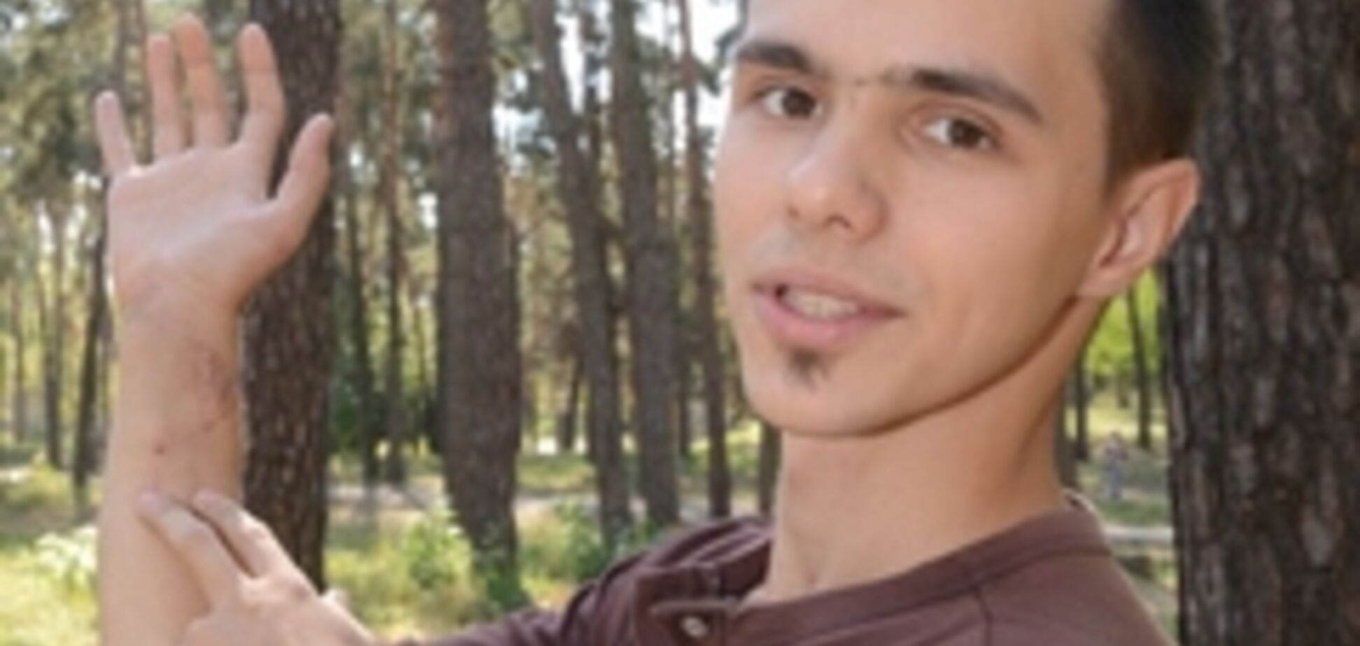 Киевские хирурги спасли 20-летнему парню руку, почти отрезанную 'болгаркой'