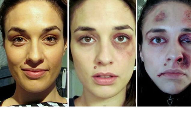 Страшное селфи: девушка показала, как менялось ее лицо после года побоев мужа
