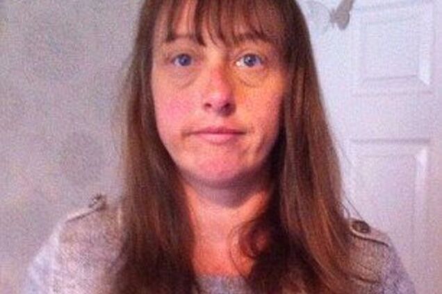 Страшная аллергия на краску для волос изуродовала женщину до неузнаваемости