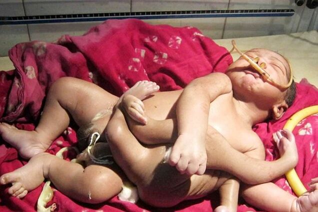 В Индии родился мальчик с четырьмя ногами и четырьмя руками