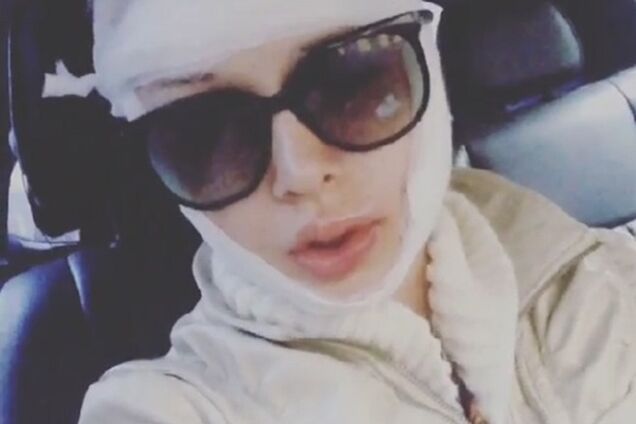 Одесская Барби заявила о нападении на нее в ночь Хеллоуина: фото с перебинтованным лицом и изрезанными губами