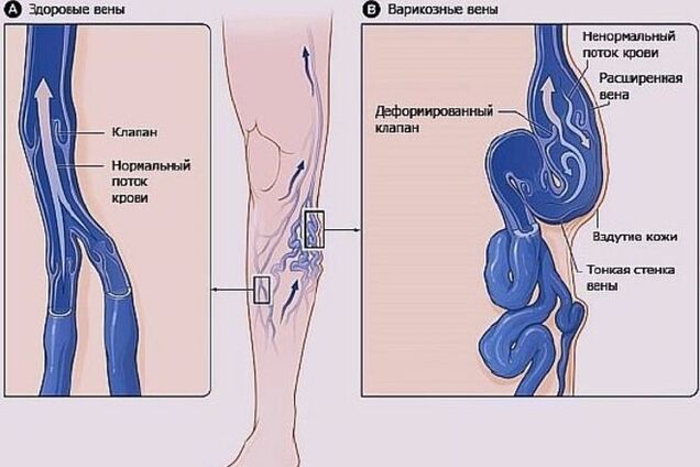 8 рецептов лечения варикоза народными средствами | Нетрадиционная медицина  | MedOboz