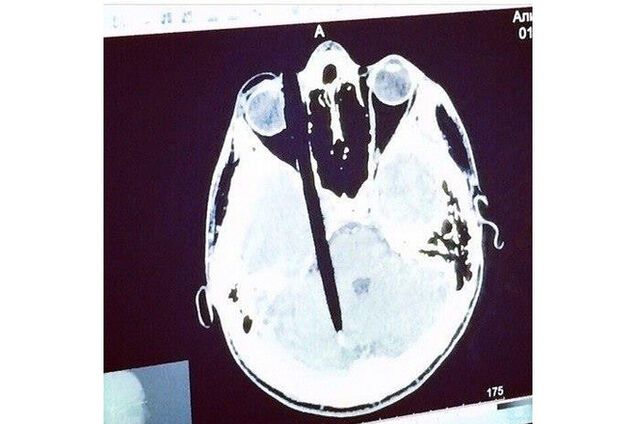 У дагестанца после допроса ФСБ РФ нашли в голове ручку: фотофакт