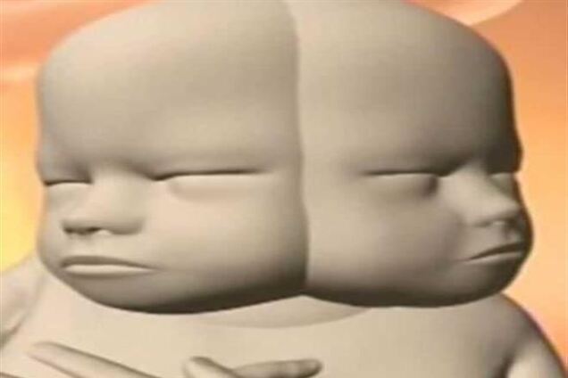 Мати сімох дітей дасть життя двоголової дитини