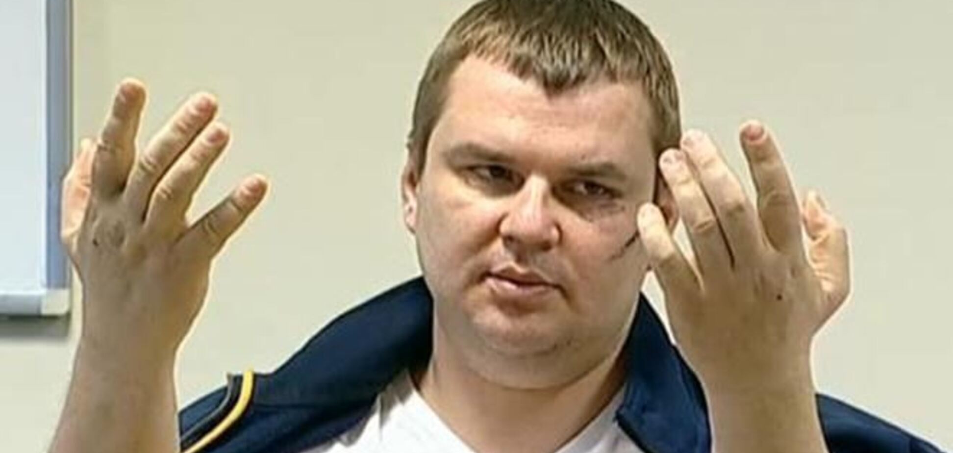 Лікуючий доктор Булатова підтвердив, що його пацієнта катували