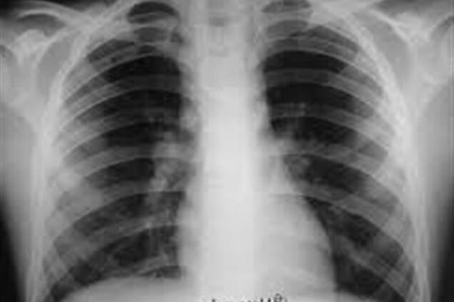 Бесплатная проверка на туберкулез в Киеве