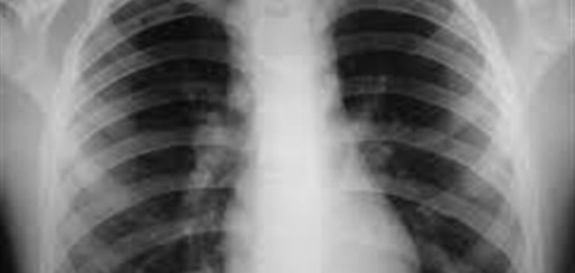 Бесплатная проверка на туберкулез в Киеве