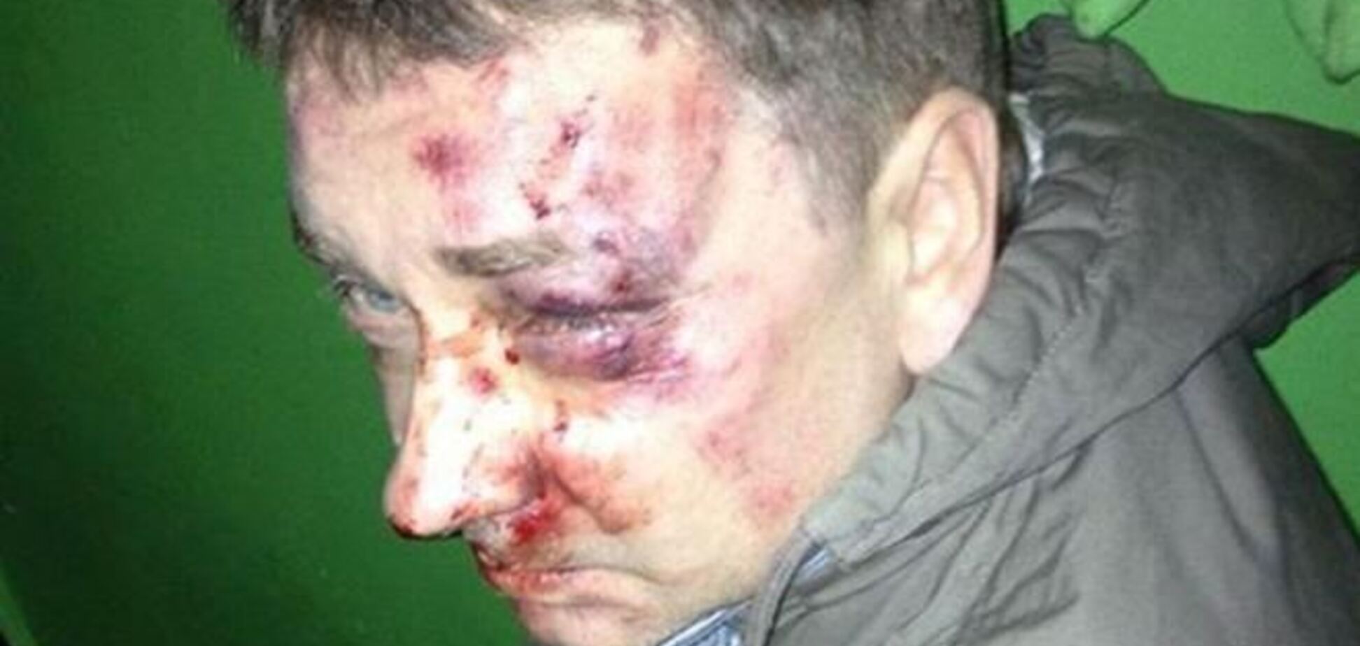 В Сумах жестоко избили журналиста