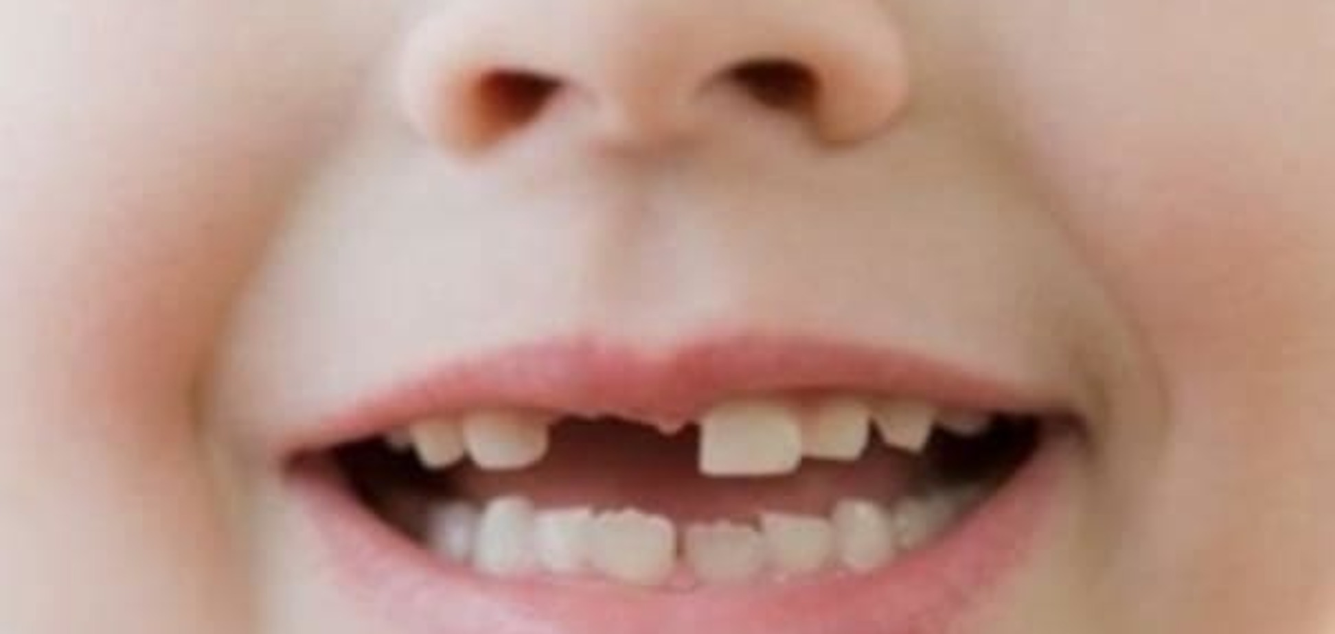 Травми зубів у дітей