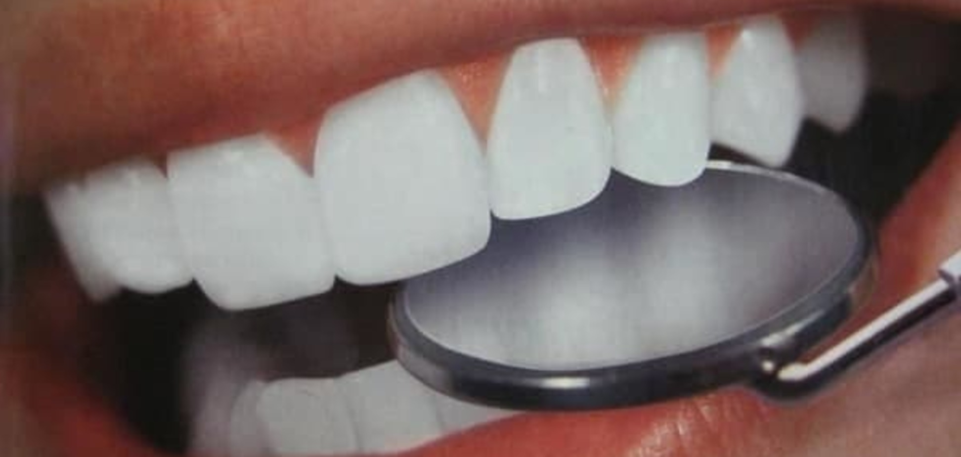 Отбеливание зубов. От теории к практике