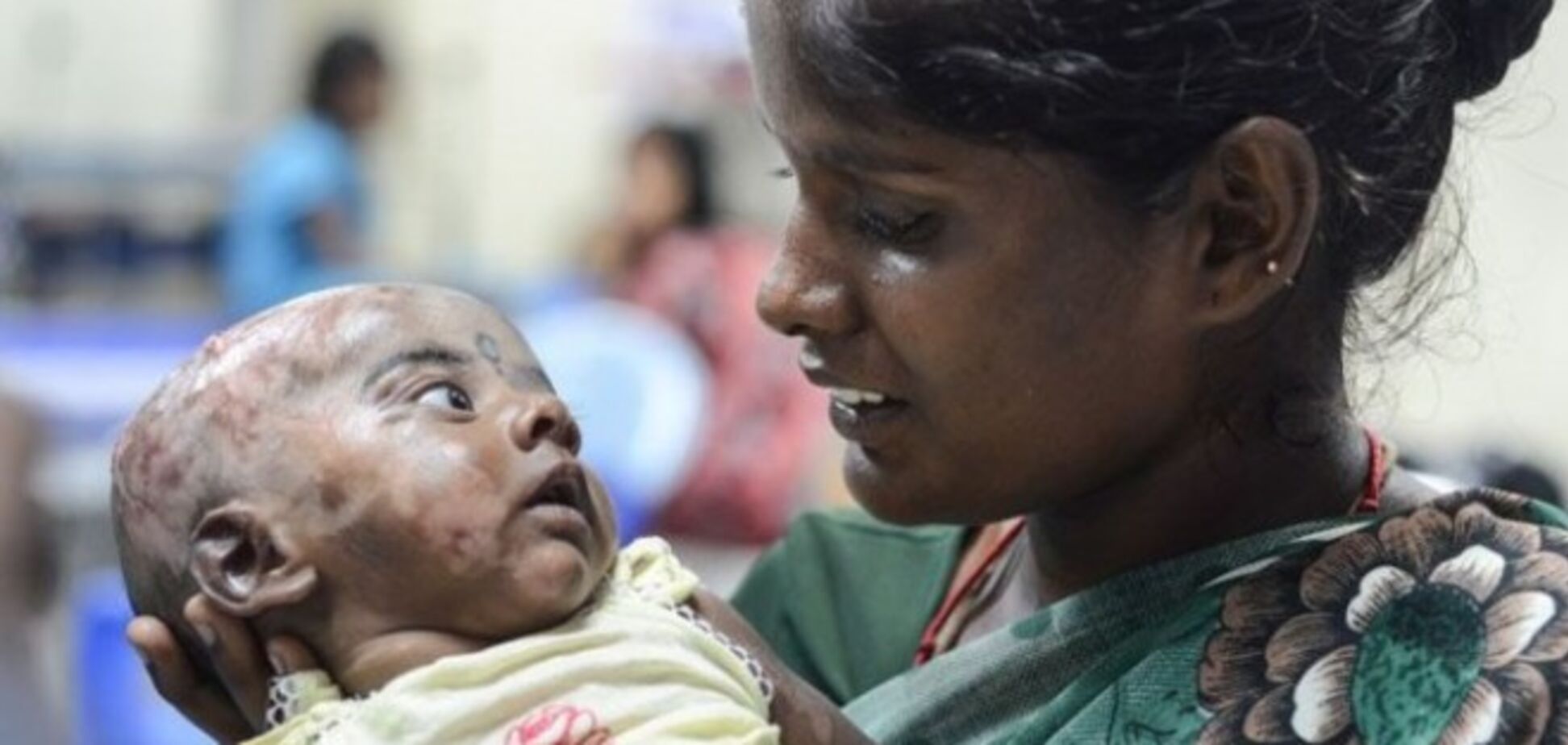 В Индии трехмесячный малыш страдает от самовоспламенения