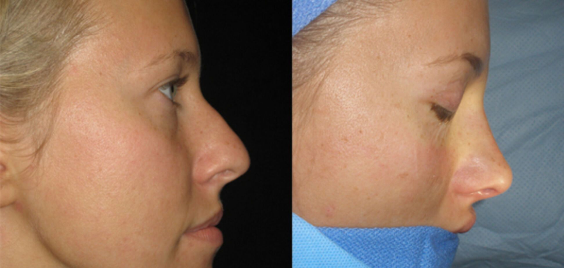 У мережі з'явилися фото до і після ринопластики Ксенії Собчак