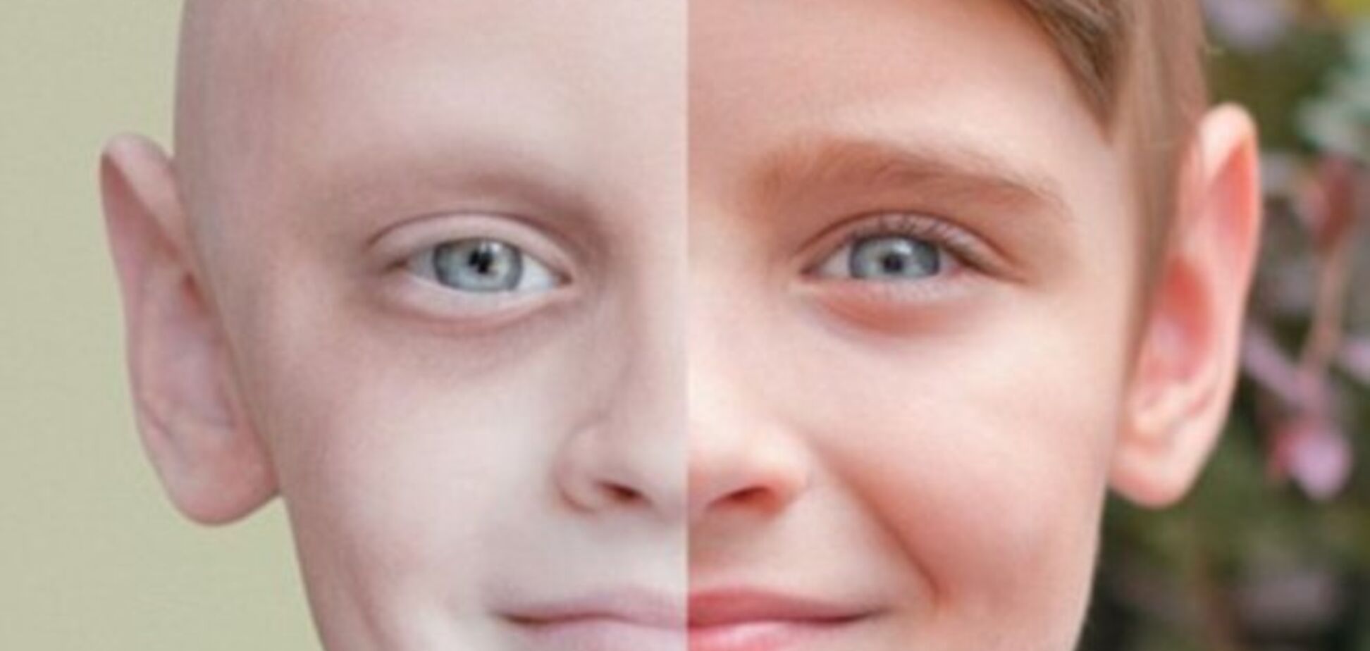 До и после победы над раком: уникальное фото ребенка