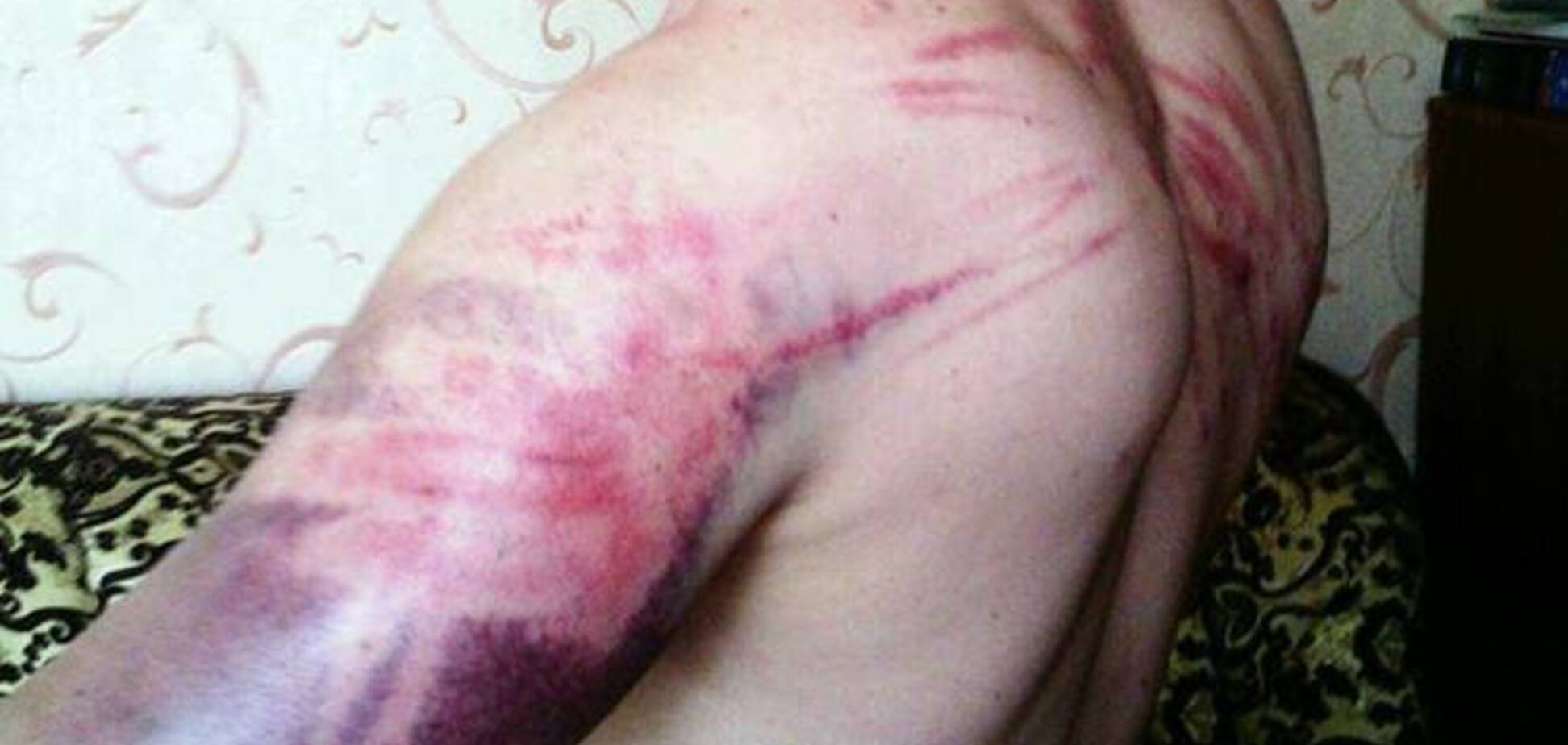 Бывший пленный 'ДНР' показал, как издевались террористы. Фотофакт