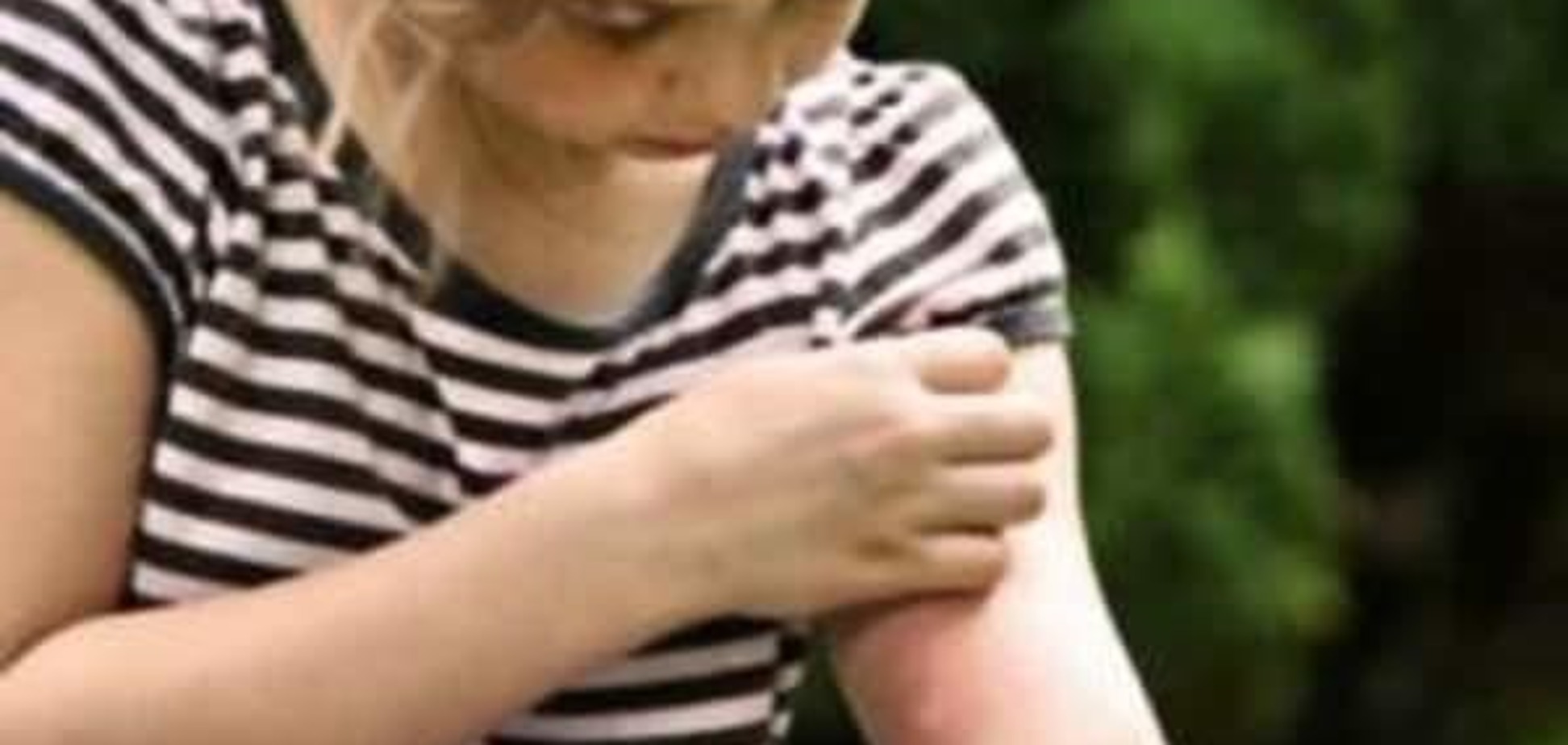 Як допомогти при алергії на укуси комарів?