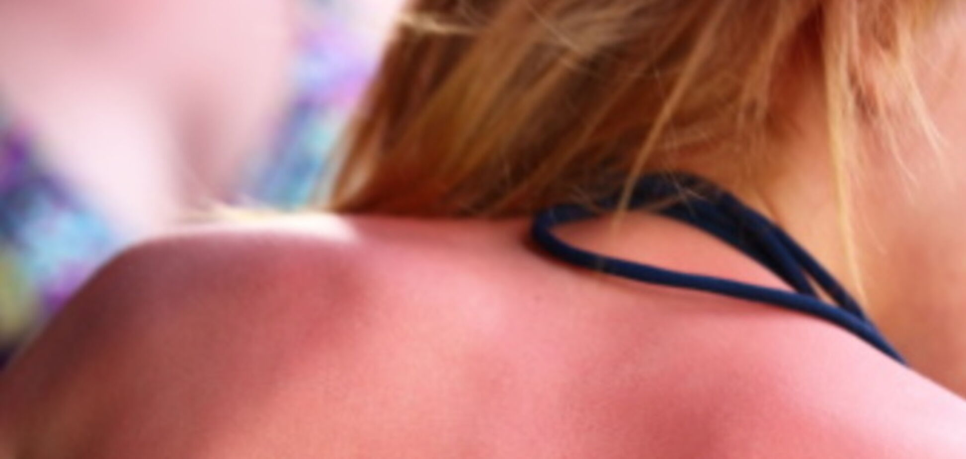 5 солнечных ожогов обеспечат рак кожи