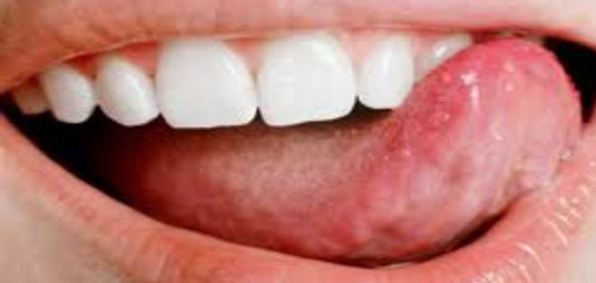 Симптомы рака языка
