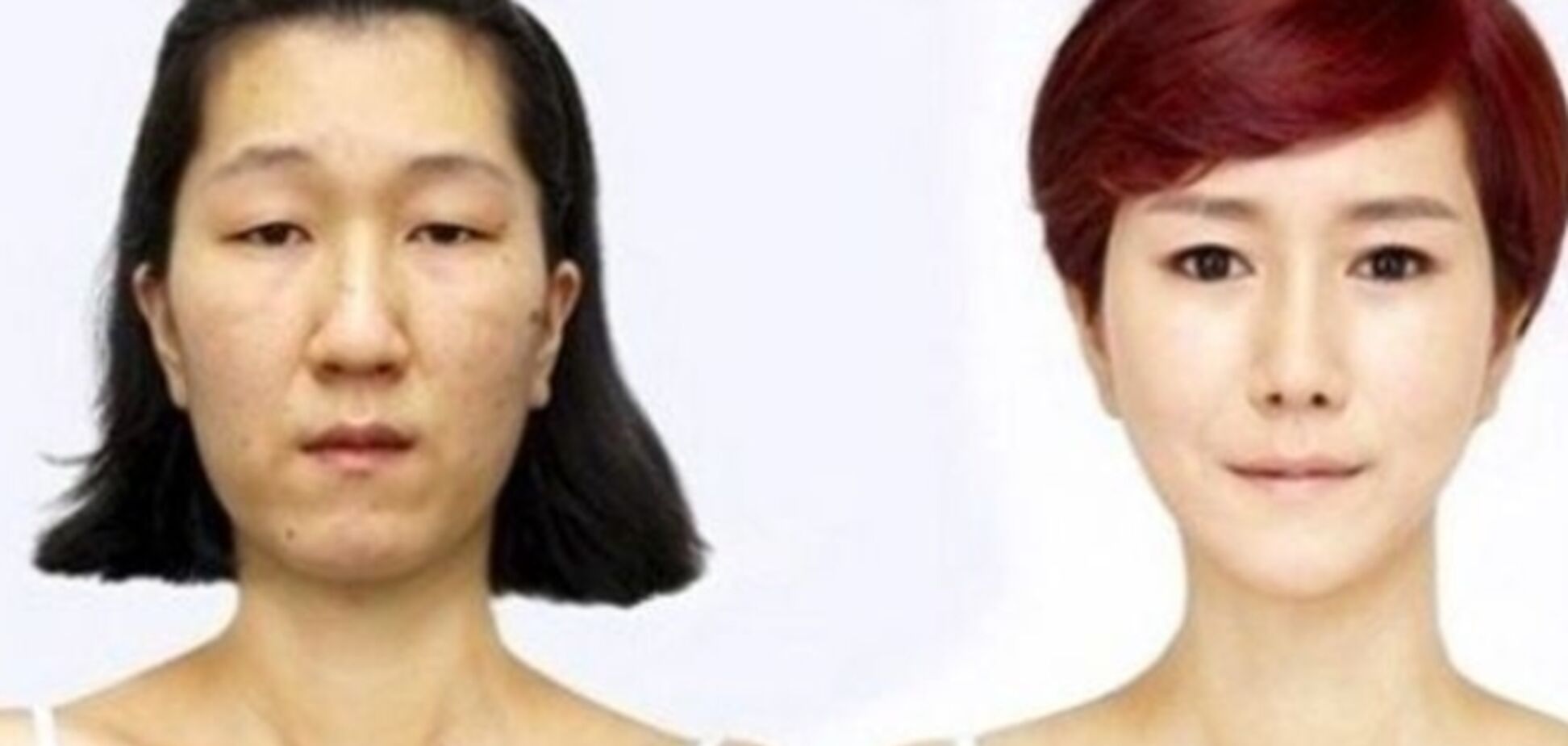 Чудеса корейской хирургии. Как врачи изменили лицо девушки