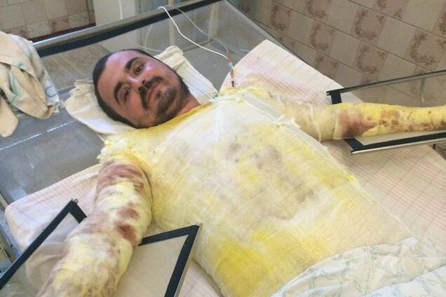 'Феникс' просит помочь раненному бойцу с 75% ожогов тела