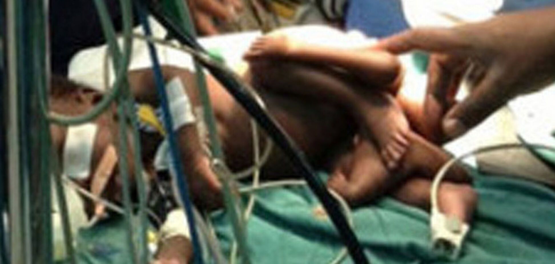 В Уганде родился мальчик, у которого были по четыре ноги и руки