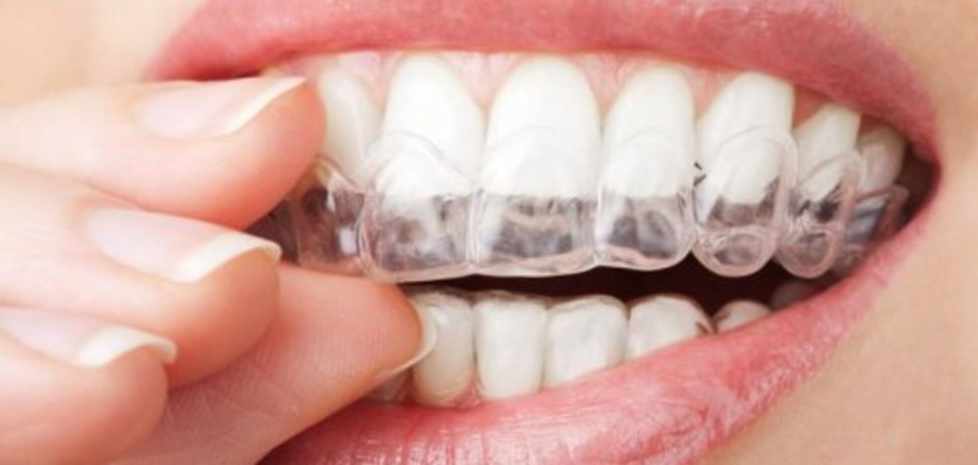 10 ошибок во время отбеливания зубов