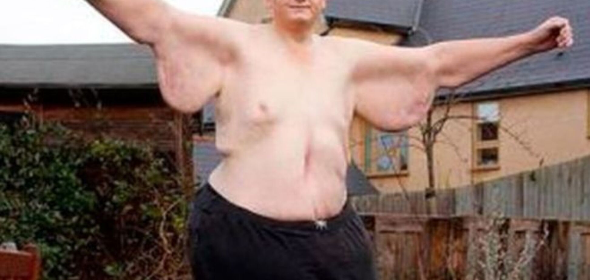 Самый толстый британец похудел на 305 кг ради любимой женщины