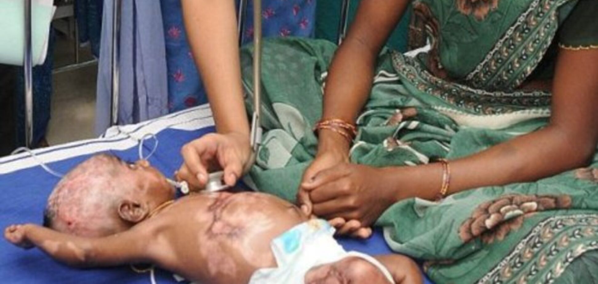 У младенца из Индии произошло 'спонтанное самовозгорание'