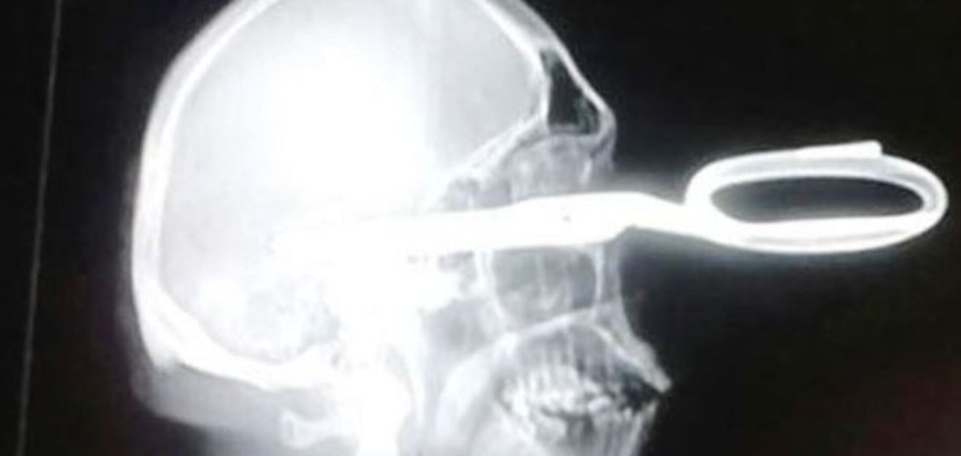 В Мексике мужчина явился в клинику, с торчавшими из головы ножницами, и спокойно заявил, что у него возникла 'небольшая проблема'