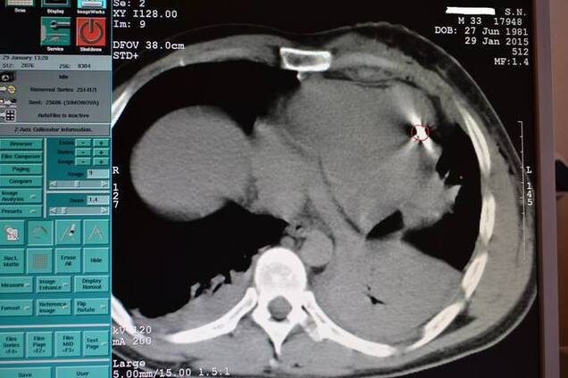 В Днепропетровске врачи спасли жизнь солдата АТО с осколком в сердце