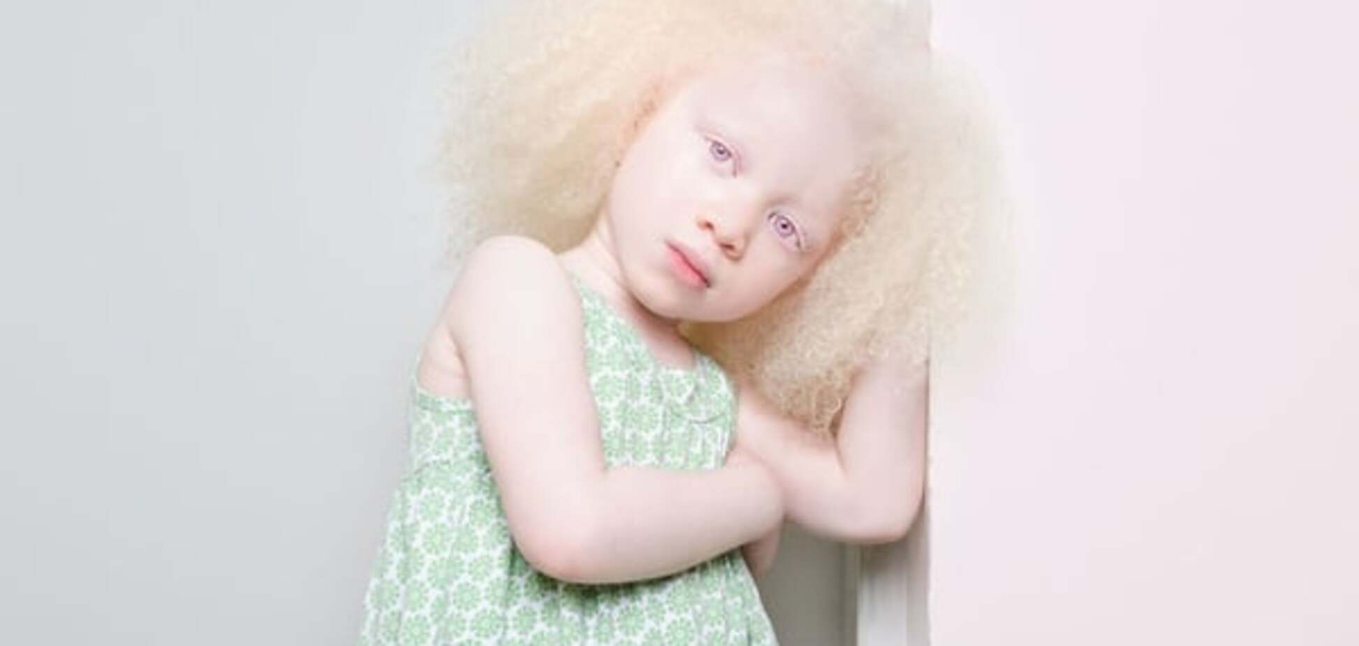 Альбиносы стали героями фотопроекта, чтобы изменить отношение к себе
