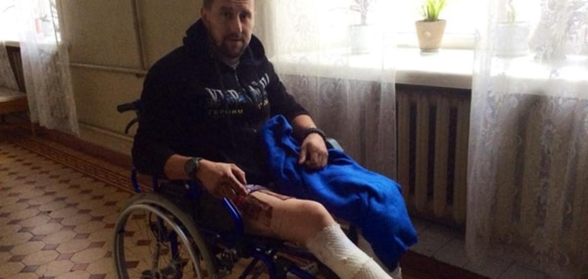 Військовий, який втратив у АТО ногу, потребує термінової допомоги