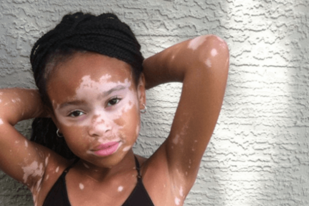 Из изгоя в модели: вдохновляющая история девочки, больной витилиго