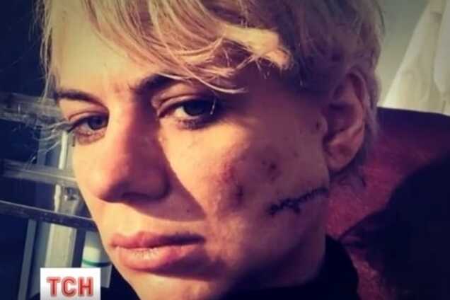 В элитном ночном клубе Киева парень порезал незнакомке лицо