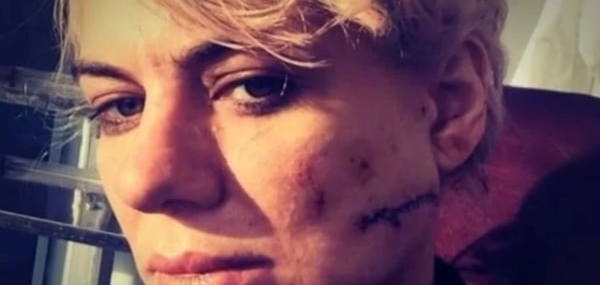 В элитном ночном клубе Киева парень порезал незнакомке лицо