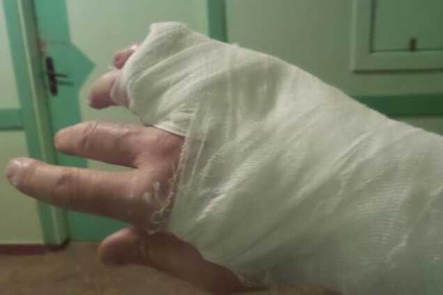 У Чернігові охоронці нардепа від БПП зламали палець журналісту: фотофакт