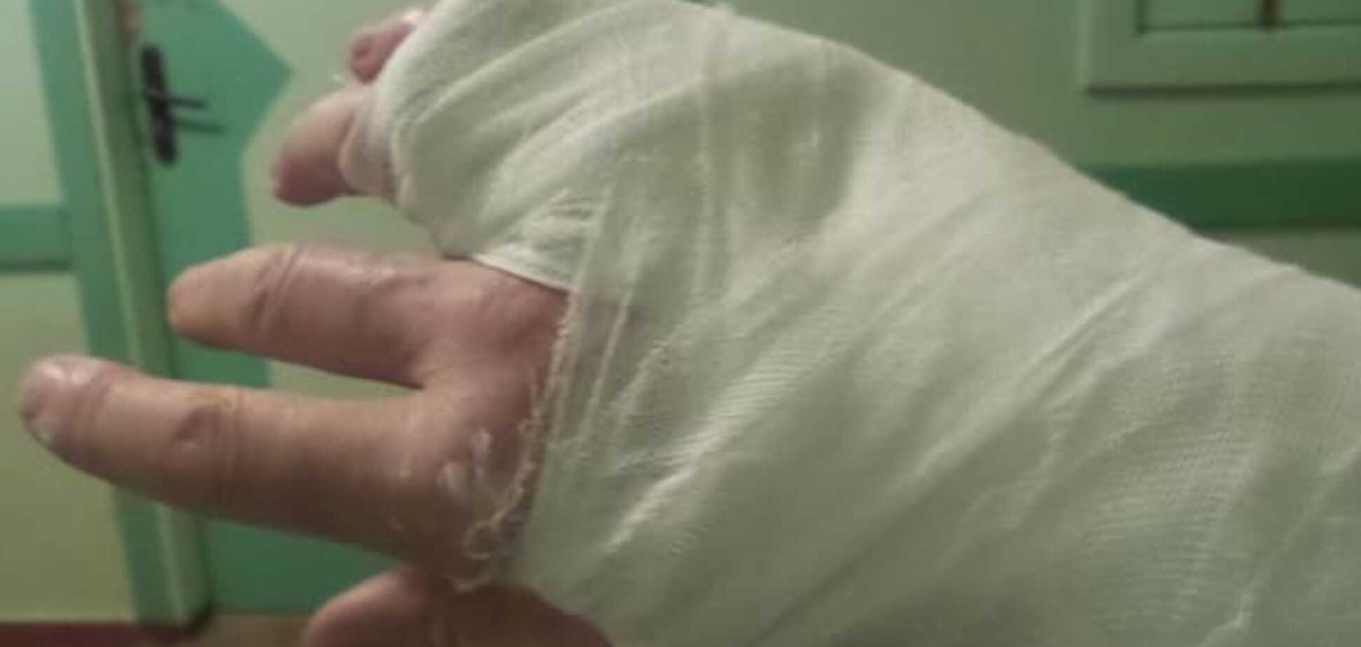 У Чернігові охоронці нардепа від БПП зламали палець журналісту: фотофакт