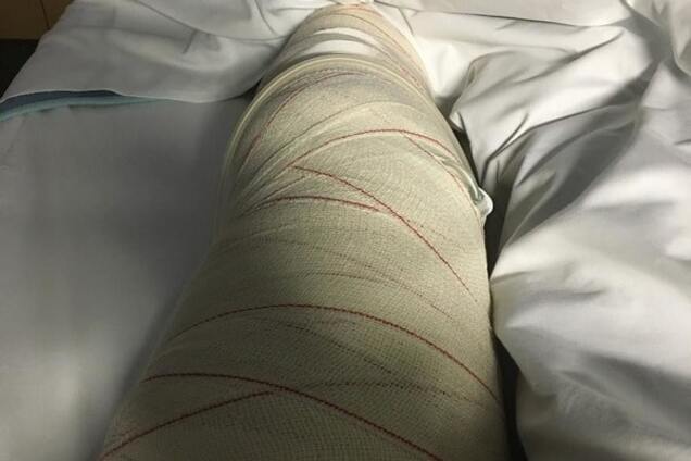 Вратарю 'Динамо' сделали операцию: фото 'пострадавшего'