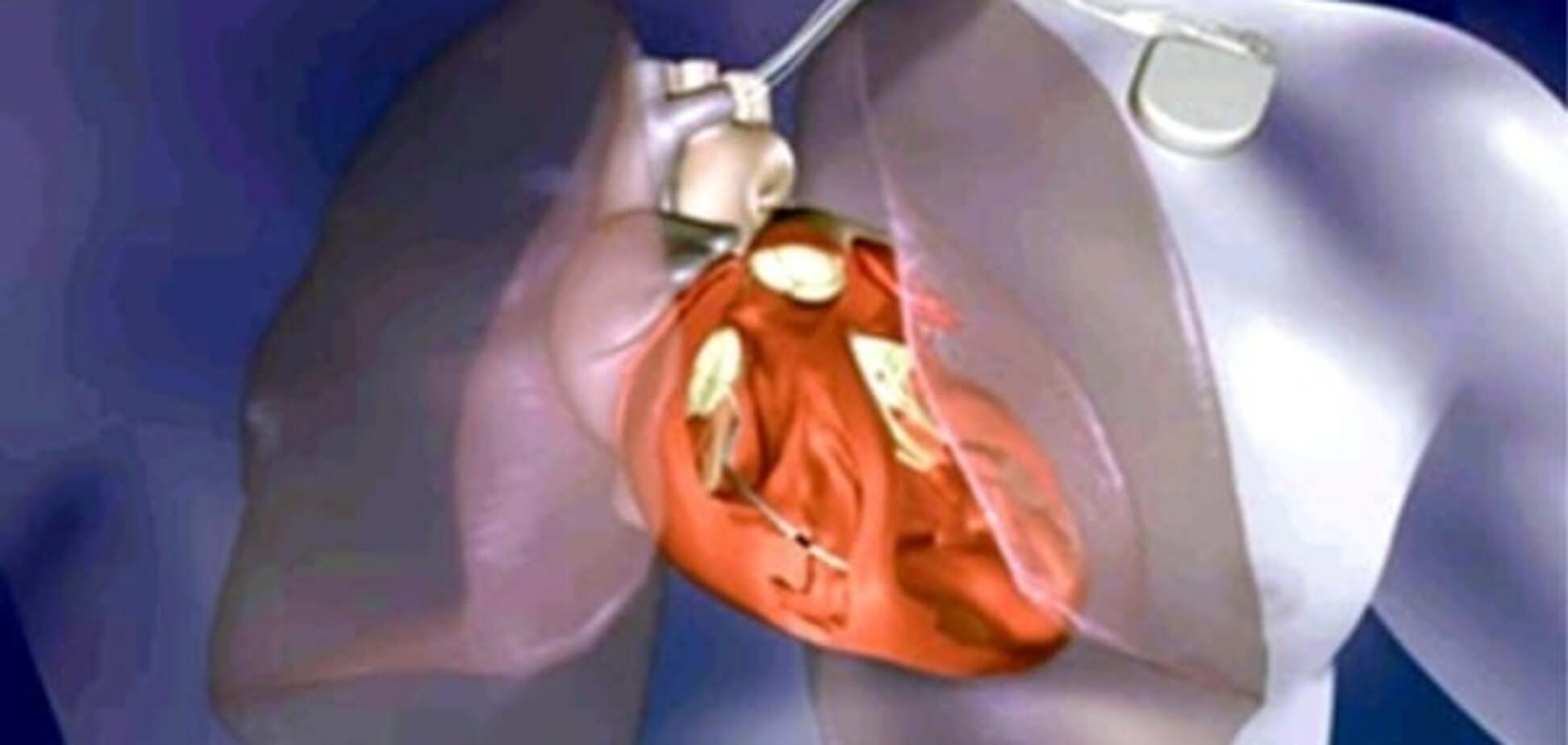 Медики з'ясували причини раптової зупинки серця