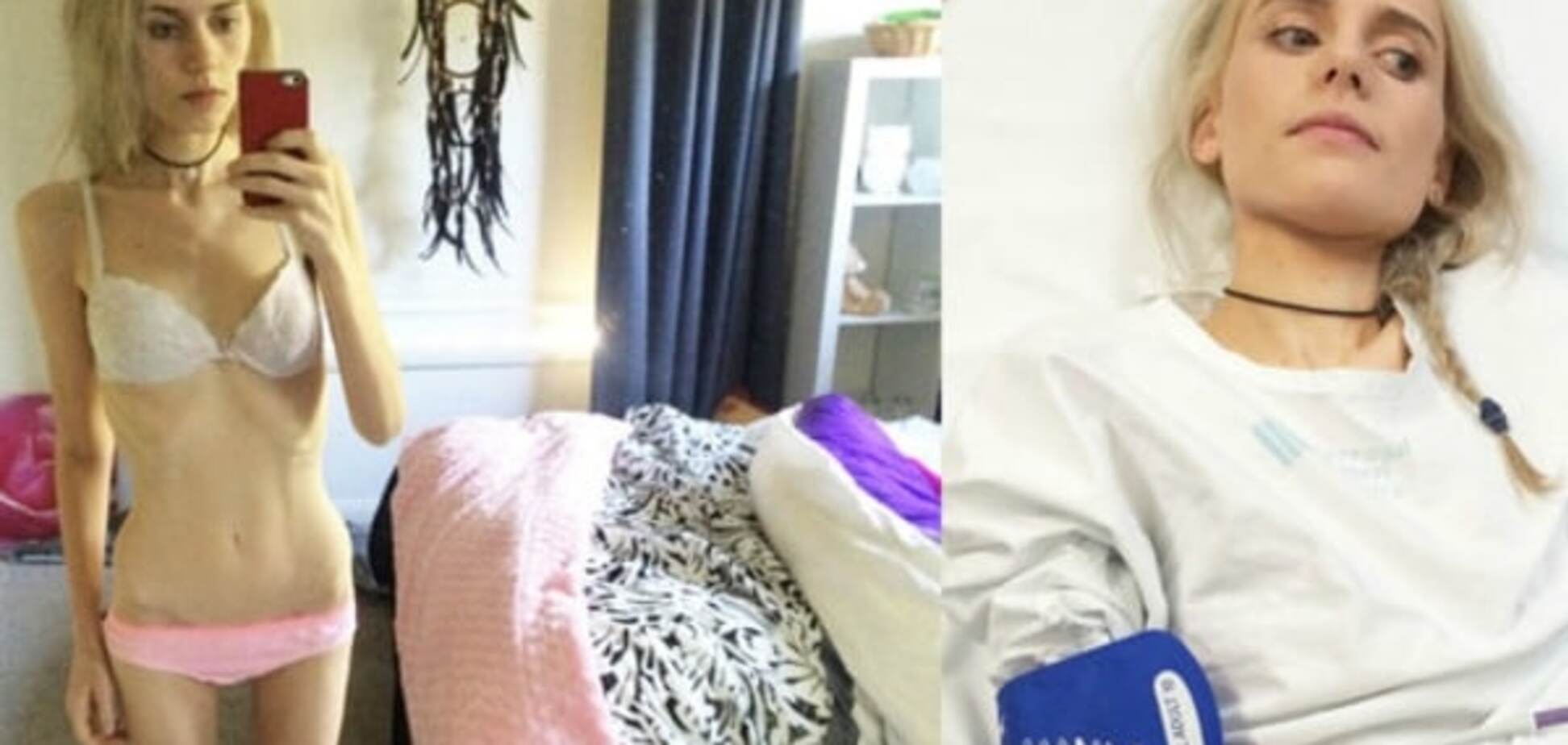 Австралійка опинилася на межі смерті, схуднувши на 40 кг через глузування в школі