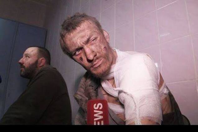 'Киборгу', которого допрашивал LifeNews, грозит ампутация руки: нужна помощь