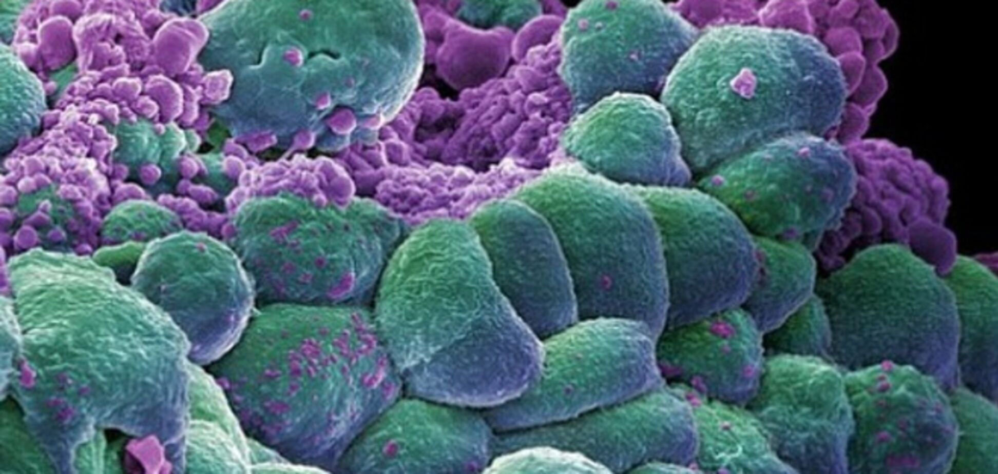 Можно ли избежать онкологических заболеваний при наличии 'раковых' генов