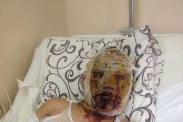 Обгоревший бурят рассказал, как росийский танковый батальон воевал под Дебальцево с закрашенными номерами