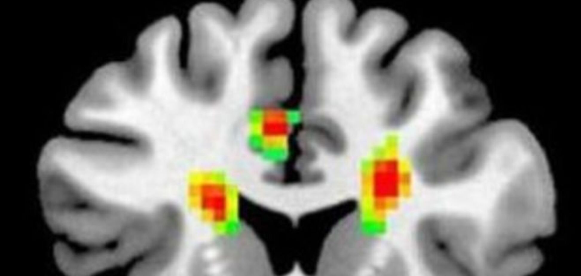 Ученые показали на снимке мозга, как выглядит любовь 