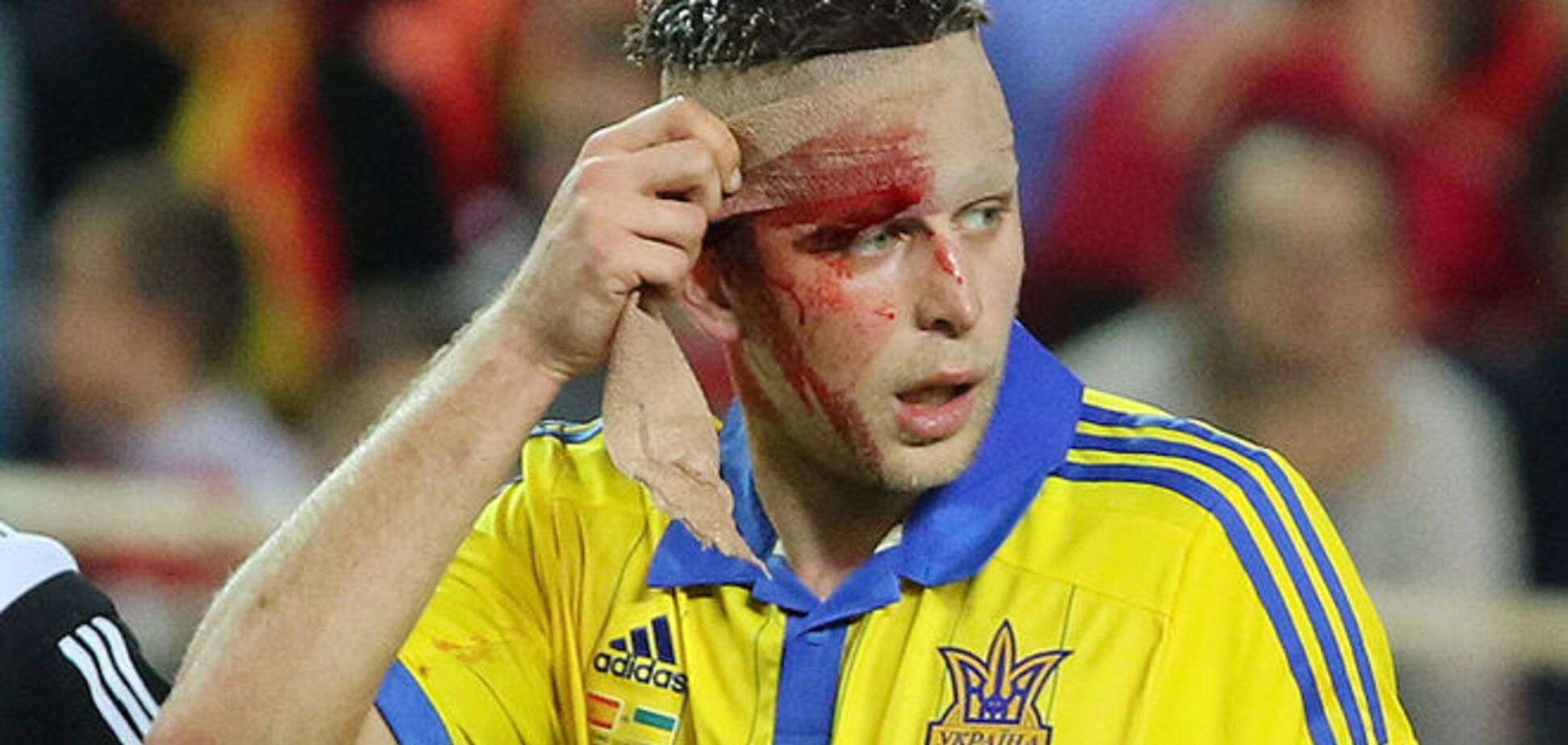 Футболисту 'Динамо' наложили швы после битвы Украины с Испанией